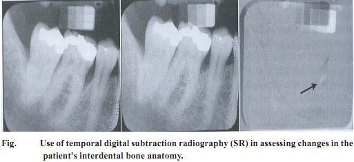 2039_Illustrate Temporal digital subtraction radiography.png